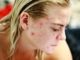 5 Reasons Make Teenager Skin Prone To Acne